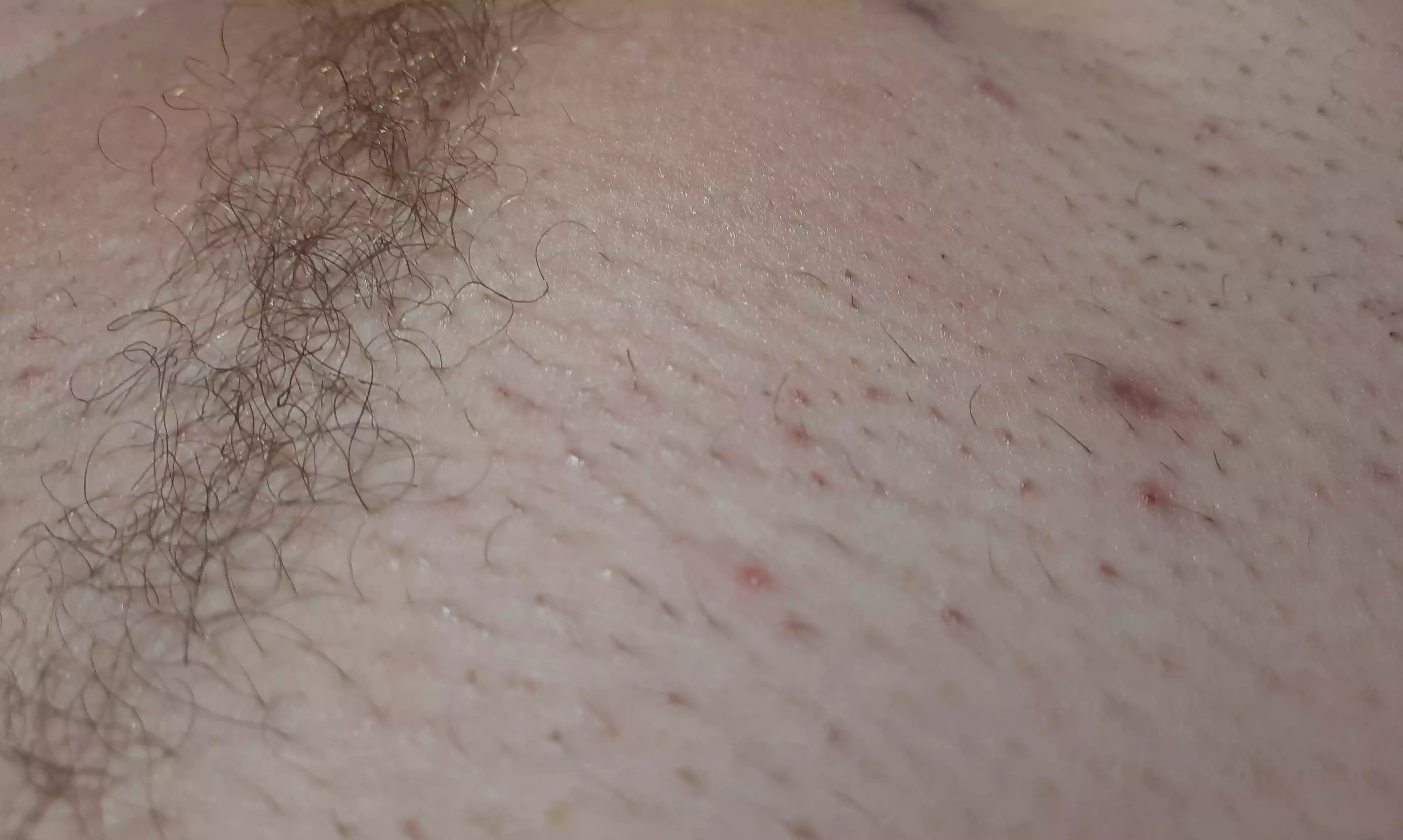Rerowth red spots in pubic waxing